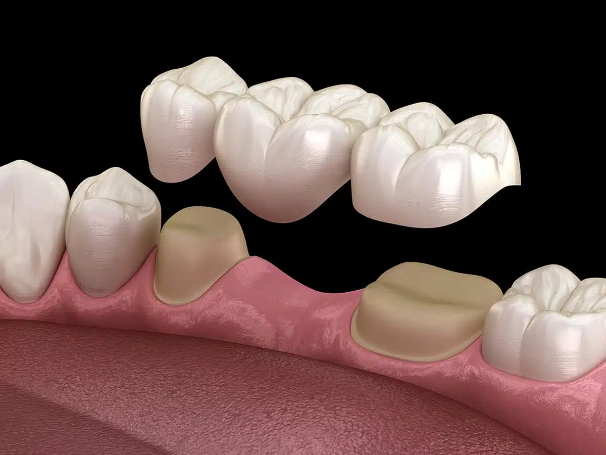 Protège dents - Laboratoire de prothèses dentaires Crown Ceram
