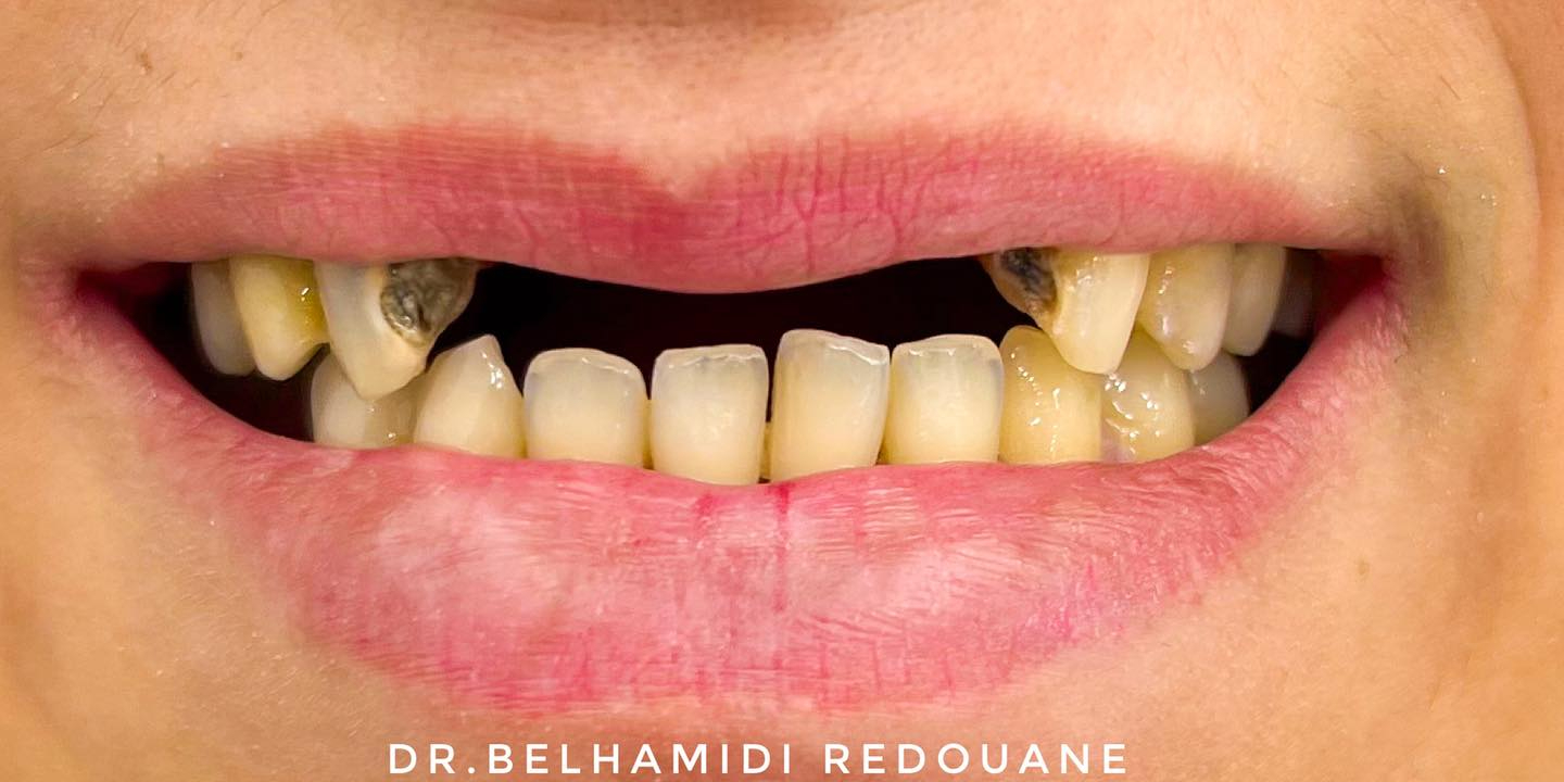 Avant Après Prothèse dentaire partielle supérieure à Blida Cabinet dentaire Dr BELHAMIDI Redouane