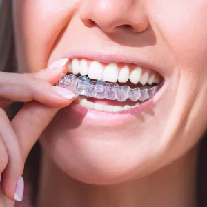 Gouttière dentaire transparente à Blida en Algérie Alignement des dents avec appareil dentaire transparent, orthodontie invisible, odf