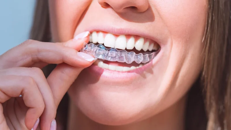 Gouttière dentaire transparente à Blida en Algérie Alignement des dents avec appareil dentaire transparent, orthodontie invisible, odf