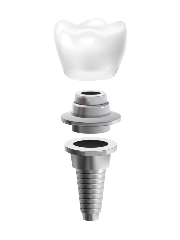 dental-implant-no-bg