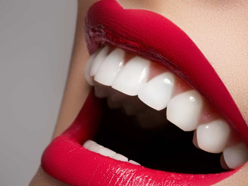 dentisterie esthétique & hollywood smile à Blida