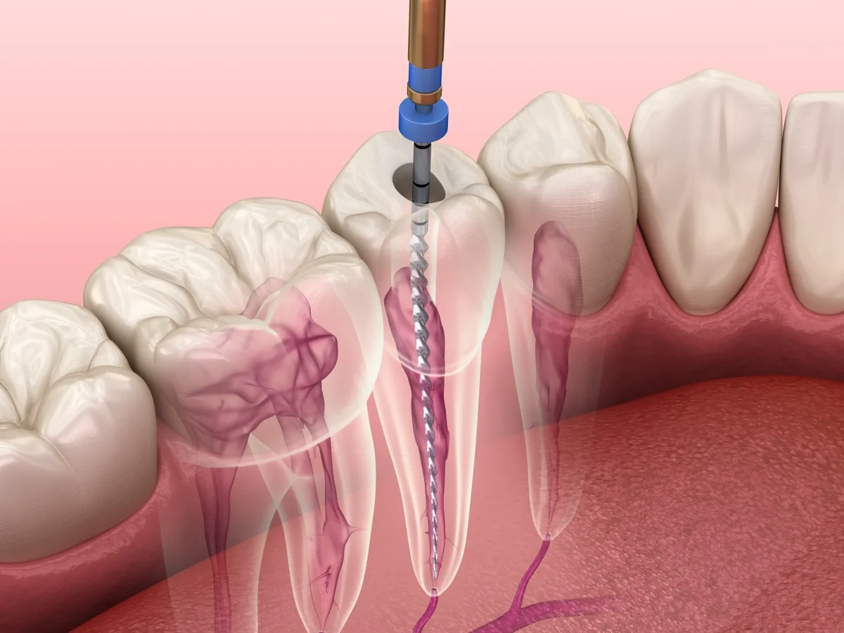 endodontiste-traitement-canalaire-blida-algerie