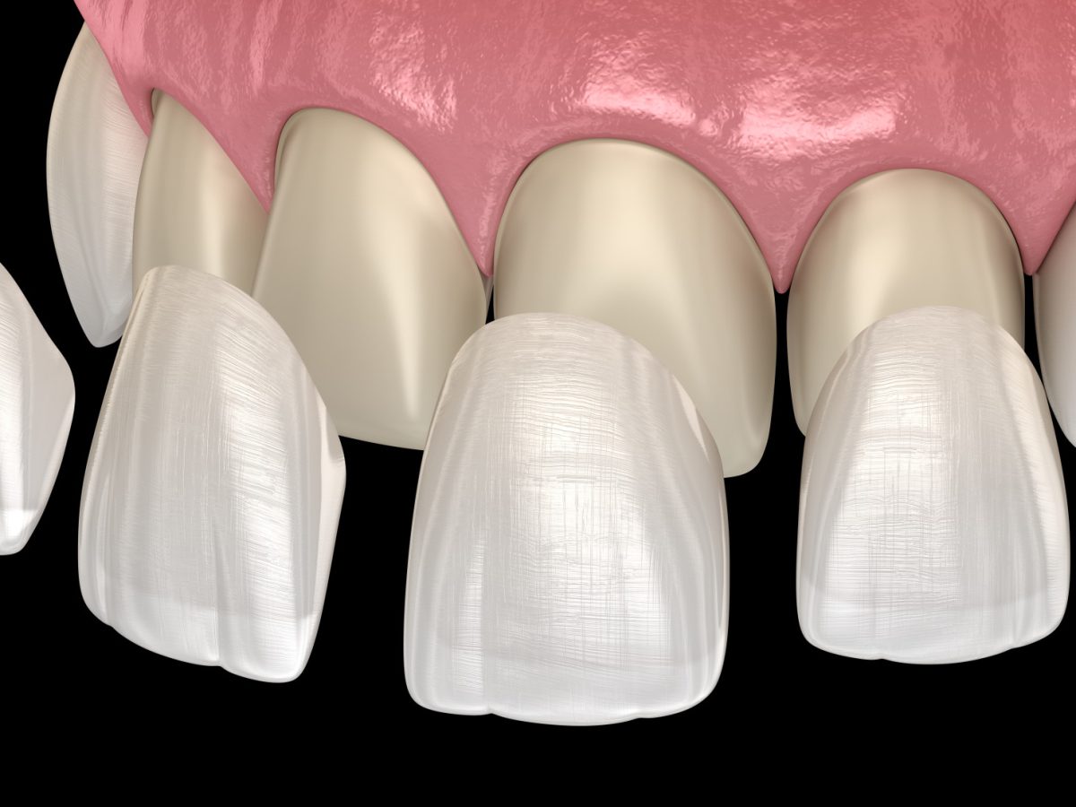 Pose de facettes dentaires sur les dents frontales à Blida en Algérie, hollywood smile avec facettes dentaires à Blida