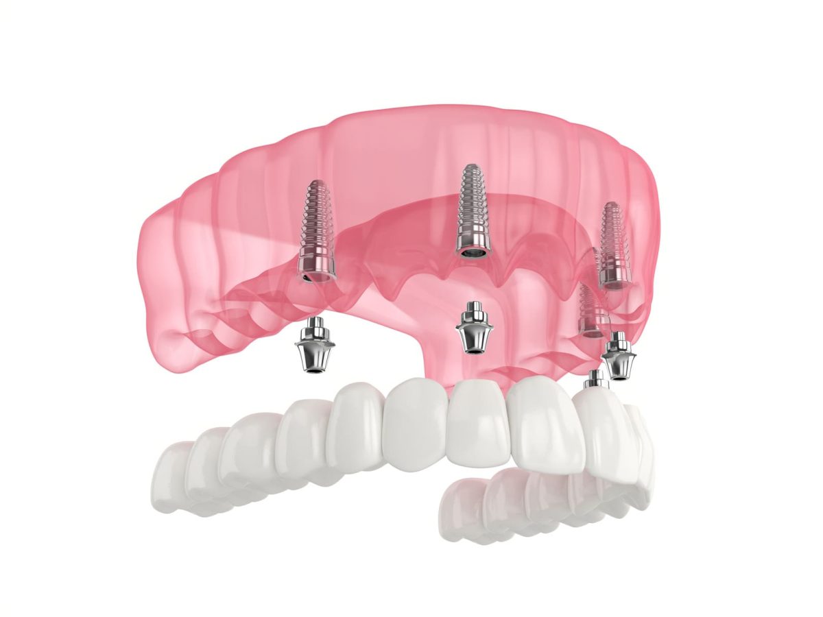 implant-dentaire-all-on-4-blida-algerie