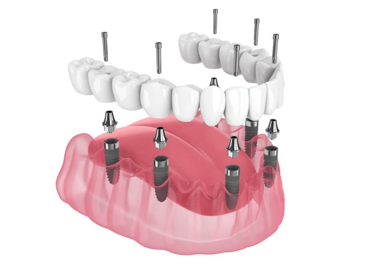 implant-dentaire-all-on-6-blida-algerie