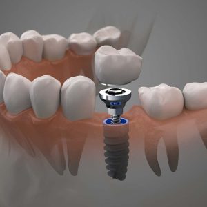Pose d'implant dentaire à Blida en Algérie, Hollywood smile avec implants dentaires à Blida