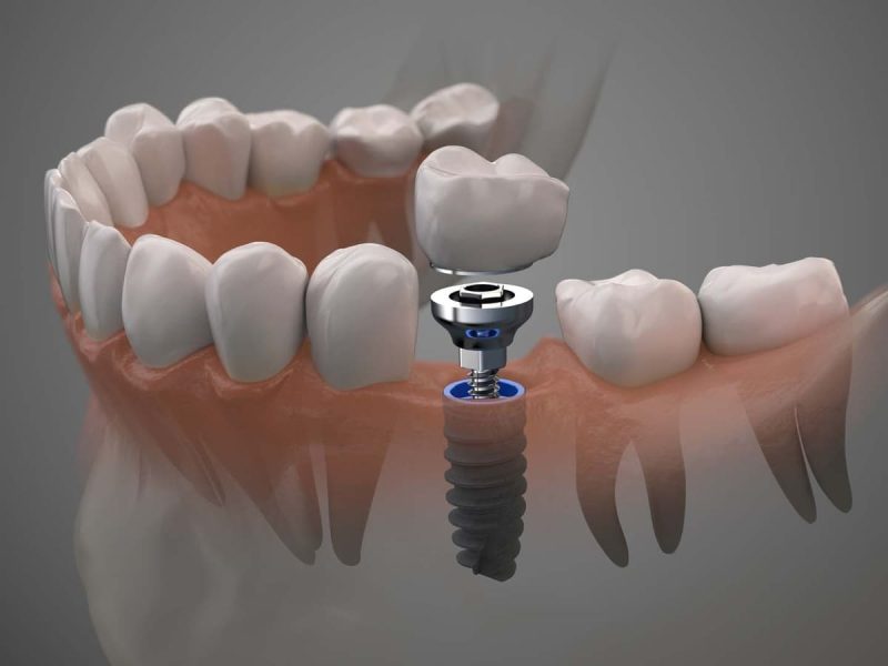 Prothèse dentaire sur implants ou traditionnelle