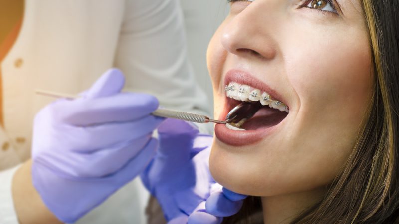 orthodontie (ODF) pour adultes