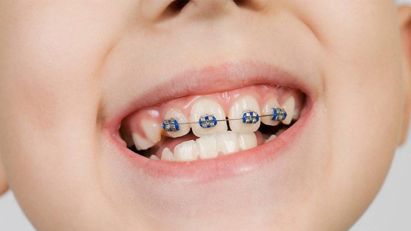 Orthodontie (ODF) pour enfants