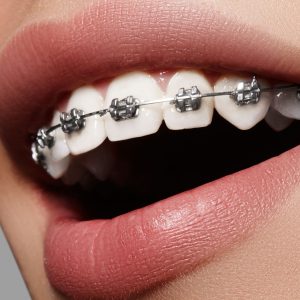 orthodontie-odf-appareil-dentaire-blida-algerie