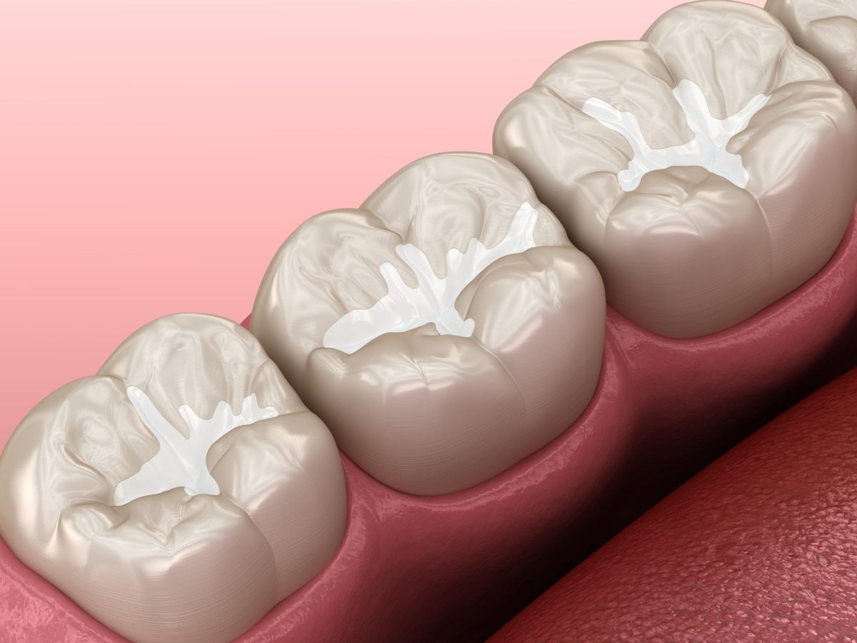 Pansement dentaire, traitement temporaire avant plombage ou couronne dentaire permanente au cabinet dentaire à Blida